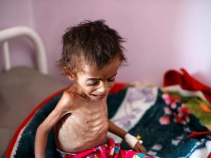 تحالف العدوان يتسبب بأكبر مجاعة إنسانية في القرن الواحد والعشرين في اليمن