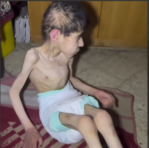 فيديو يدمي القب.. الجوع يفتك بأجساد أطفال غزة (شاهد)