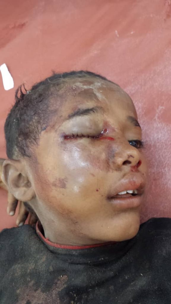 #الحديدة: تعرض طفلة لإصابات بالغة بقصف قوى العدوان على التحيتا