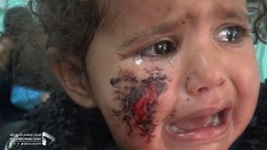 بالصور.. اصابة طفلة في الثانية من عمرها بغارة لطائرات العدوان في صعدة