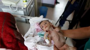 المتحدث باسم وزارة الصحة: 100 ألف طفل يمني يموتون سنويا بسبب الحرب والحصار