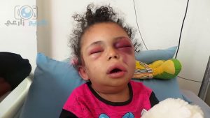 الطفلة بثينة..  من القصف والخطف إلى العودة لعنة تلاحق النظام السعودي