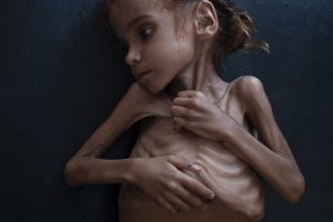 أطفال اليمن.. نريد البقاء على قيد الحياة..!؟